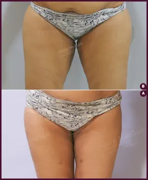 female large thigh liposuction surgery cost in Mumbai Dr. Milan Doshi