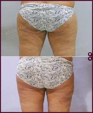 female large thigh liposuction surgery best cost in India