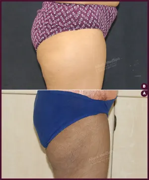female medium thigh liposuction surgery cost in Mumbai, India