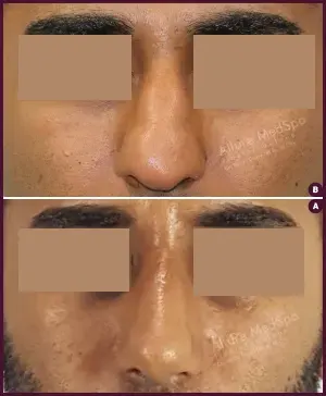 nose reshaping rhinoplasty surgery before and after