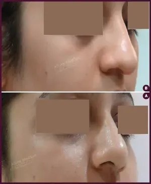 profile plasty nose surgery results cost in mumbai