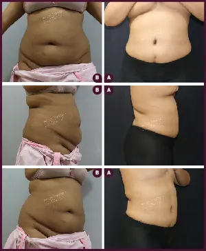 before and after images of tummy tuck surgery on female abdomen in mumbai by best plastic surgeon