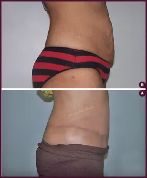 Female Extended Tummy Tuck Surgery Before and After Images