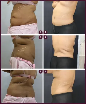 Female Medium Tummy Tuck Surgery Before and After photos