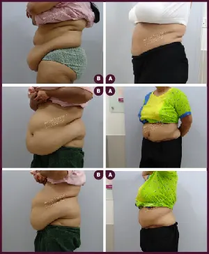 Female Extra Large Tummy Tuck Surgery Before and After photos