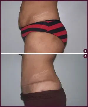 Female Extended Tummy Tuck Surgery Before and After Images