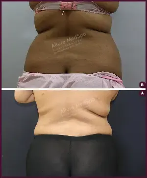 Female Medium Tummy Tuck Surgery Before and After