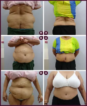 Female Extra Large Tummy Tuck Surgery Before and After mumbai