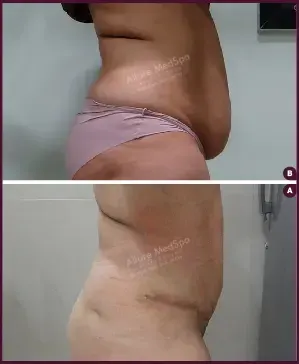 Female Medium Tummy Tuck Surgery Before and After cost