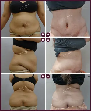 Female large Tummy Tuck Surgery Before and After mumbai
