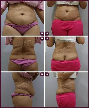 Tummy Tuck surgery Before and After images of female abdomen fat at affordable cost in Mumbai