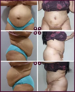 Female large Tummy Tuck Surgery Before and After india