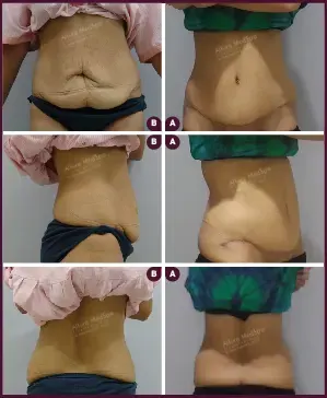 Female small tummy tuck before and after mumbai