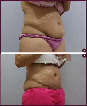 Female Medium Tummy Tuck Before and After