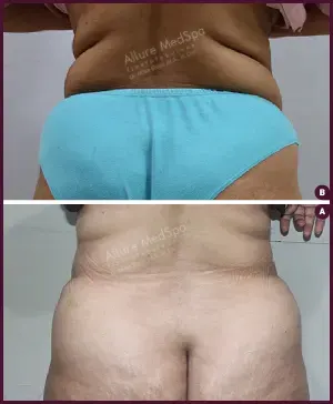 Female large Tummy Tuck Surgery Before and After cost