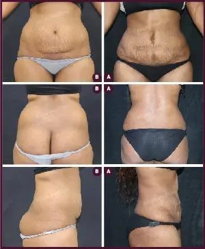 Female Medium Tummy Tuck Before and After mumbai