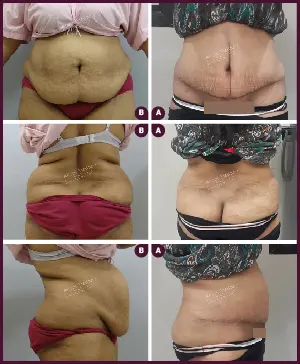 Female large Tummy Tuck Surgery Before and After photos