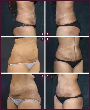 Female Medium Tummy Tuck Before and After india