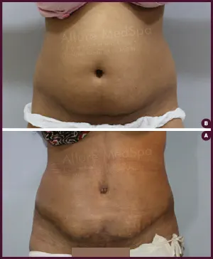 Female Medium Tummy Tuck surgery Before and After india
