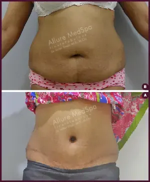 Female large Tummy Tuck Before and After photos