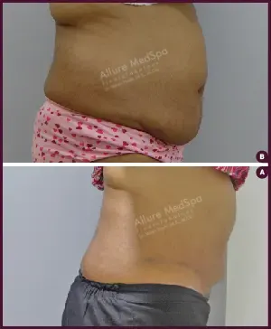 Female large Tummy Tuck Before and After images