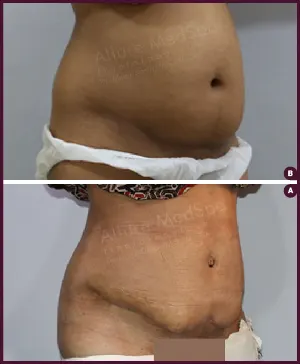 Female Medium Tummy Tuck surgery Before and After mumbai