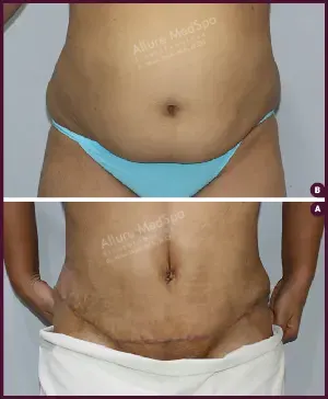 Female large Tummy Tuck Before and After cost