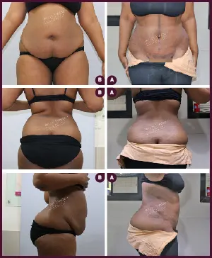 Female large Tummy Tuck Before and After mumbai
