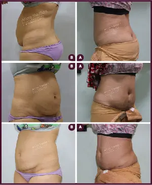 Female Medium abdominoplasty Before and After india