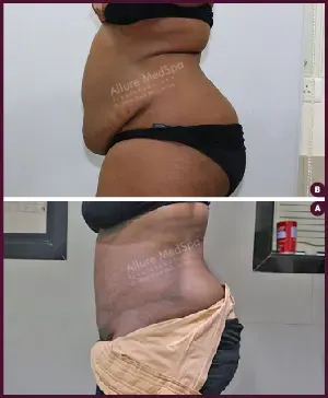 Female large Tummy Tuck Before and After india