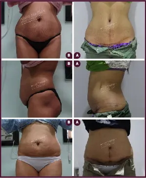 Female Medium abdominoplasty Before and After cost