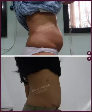 Female Medium abdominoplasty Before and After