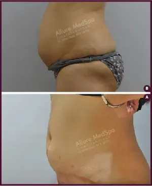 Female Medium abdominoplasty Before and After photos