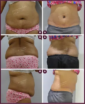Female Medium abdominoplasty Before and After images