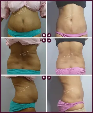 Female Medium abdominoplasty Before and After images india