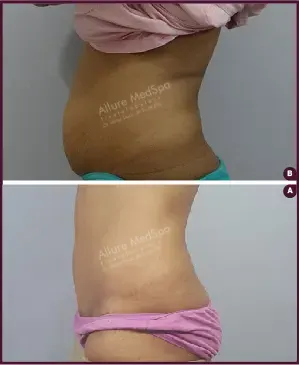 Female Medium abdominoplasty Before and After images cost