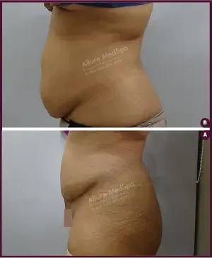 Female Medium abdominoplasty Before and After photos cost