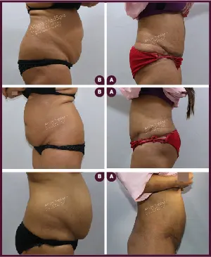 Female Medium abdominoplasty Before and After photos mumbai