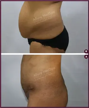 Female Medium abdominoplasty Before and After photos india