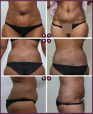 Female Medium abdominoplasty Before and After photos mumbai india