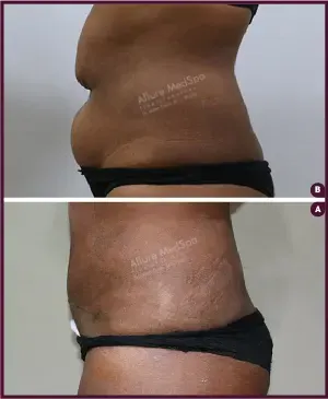 Female Medium abdominoplasty Before and After photos mumbai india