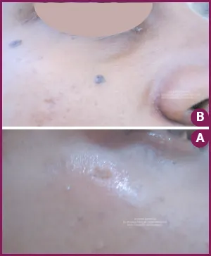 Mole, Wart & Skin Tag Removal Treatment in cost In Mumbai