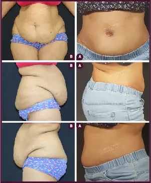 Belt Plasty Female Large Before and After Images