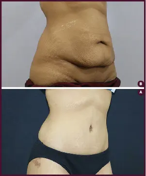 Belt Plasty with Butt Augmentation Before and After Images