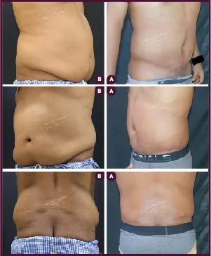 Belt Plasty Male Before and After Images