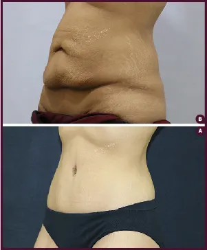Belt Plasty with Butt Augmentation Before and After Images