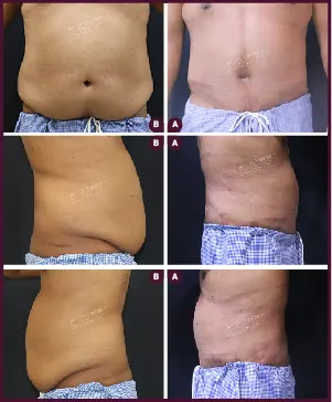 Belt Plasty Male Before and After Images