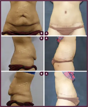 Belt Plasty Female Large Before and After Images