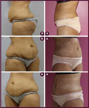 Belt Plasty Female medium Before and After photos