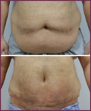 Male Extended Tummy Tuck Surgery Before and After Images